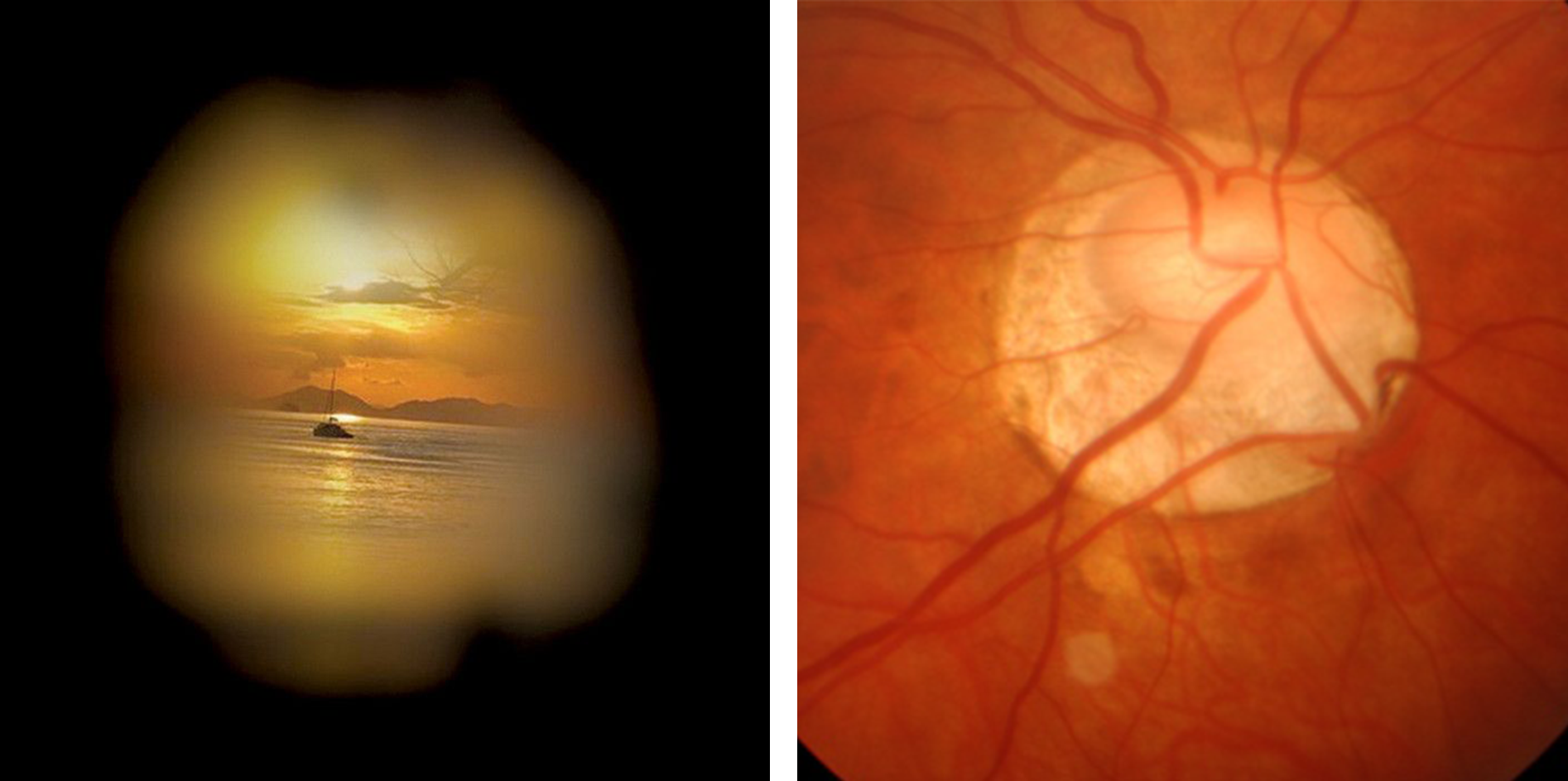 glaucoma page